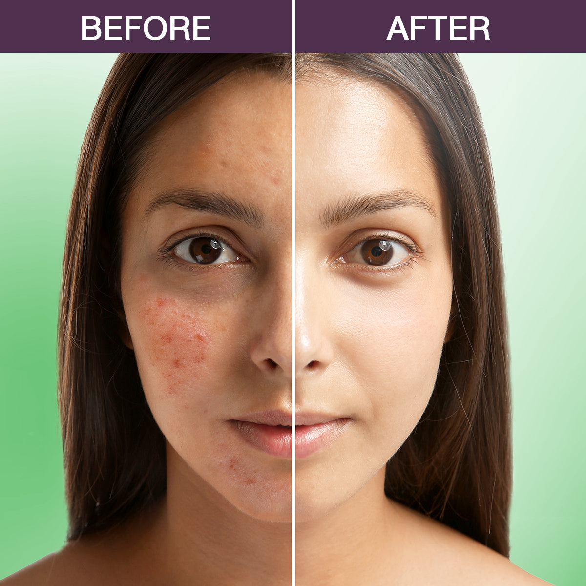 Tea Tree Mulberry Acne Buster Serum